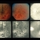 Eales Disease Eales Disease